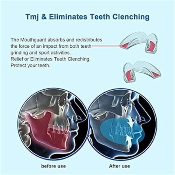 Kids Mouth Guard for Teeth Grinding, Pack of 4 Bite Guards + Dental Guard Case - Picture 3 of 6